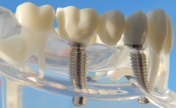 Implantate Fehlende Zähne können heute durch moderne Implantatversorgungen ersetzt werden. Das Implantat stell eine künstliche Zahnwurzel dar, die im Kieferknochen verankert und mit einem Zahnersatz versorgt wird. Manchmal zuvor ein Knochenaufbau notwendig.Der Ersatz durch Implantate bietet viele Vorteile.Oft kann durch den Einsatz von Implantaten ein abnehmbarer Ersatz vermieden und somit eine komfortabler Lösung gefunden werden. Beim Ersatz von einzelnen Zähnen müssen die Nachbarzähne nicht mitbehandelt werden.In Kombination mit abnehmbaren Zahnersatz kann dieser wesentlich graziler gestaltet werden und zu einer Verbesserung des Halts beitragen.