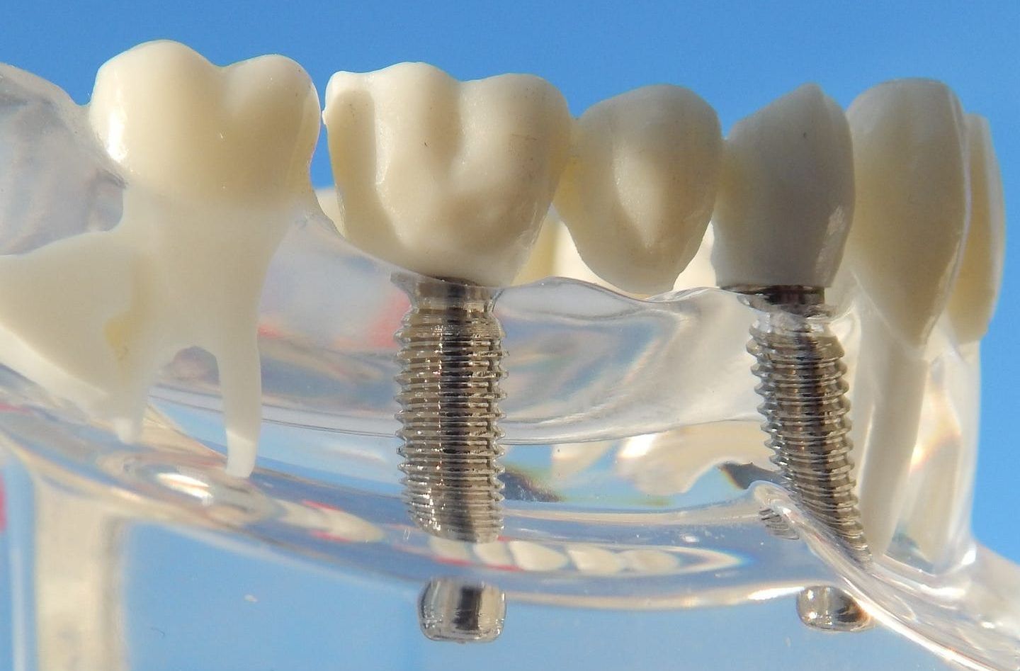 Fehlende Zähne können heute durch moderne Implantatversorgungen ersetzt werden. Das Implantat stell eine künstliche Zahnwurzel dar, die im Kieferknochen verankert und mit einem Zahnersatz versorgt wird. Manchmal zuvor ein Knochenaufbau notwendig.Der Ersatz durch Implantate bietet viele Vorteile.Oft kann durch den Einsatz von Implantaten ein abnehmbarer Ersatz vermieden und somit eine komfortabler Lösung gefunden werden. Beim Ersatz von einzelnen Zähnen müssen die Nachbarzähne nicht mitbehandelt werden.In Kombination mit abnehmbaren Zahnersatz kann dieser wesentlich graziler gestaltet werden und zu einer Verbesserung des Halts beitragen.